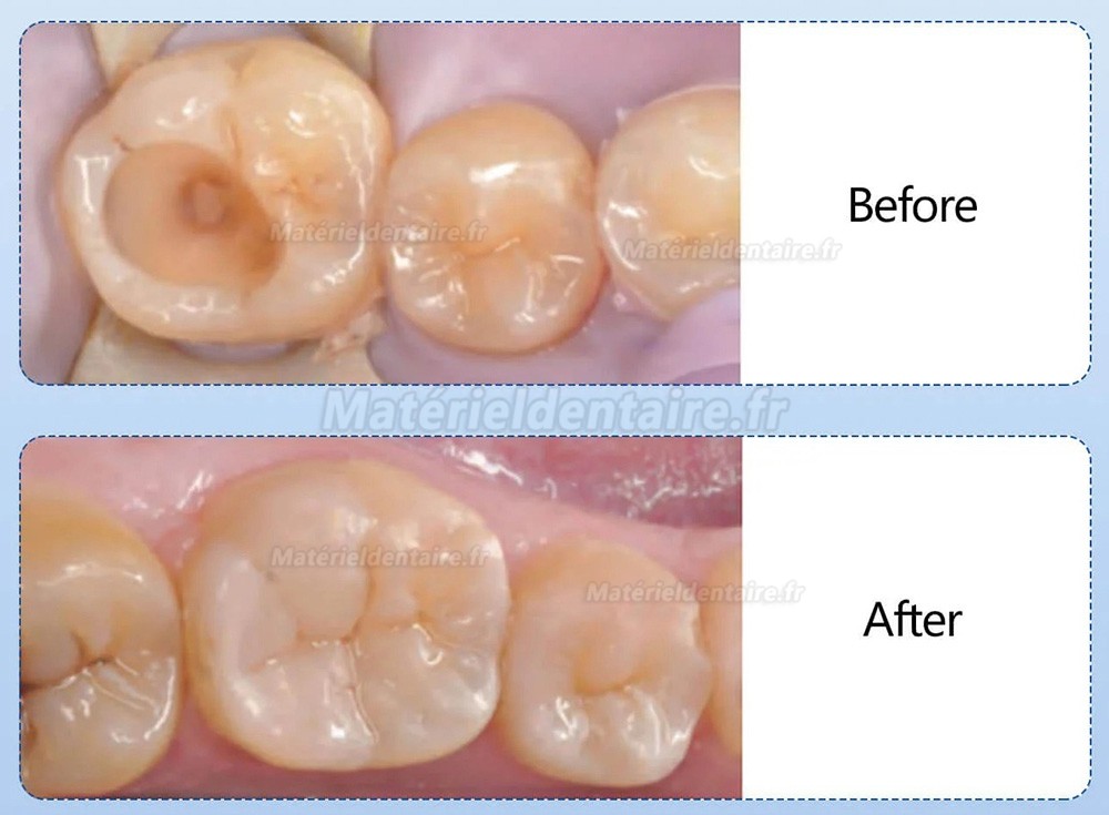 10 Capsules/boîte A1/A2/A3/A3.5 Résine composite dentaire photopolymérisable